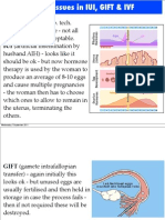 IUI (Artificial Insemination By: Wednesday 7 September 2011