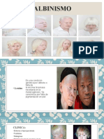 Albinismo-Trastorno genético falta pigmentación
