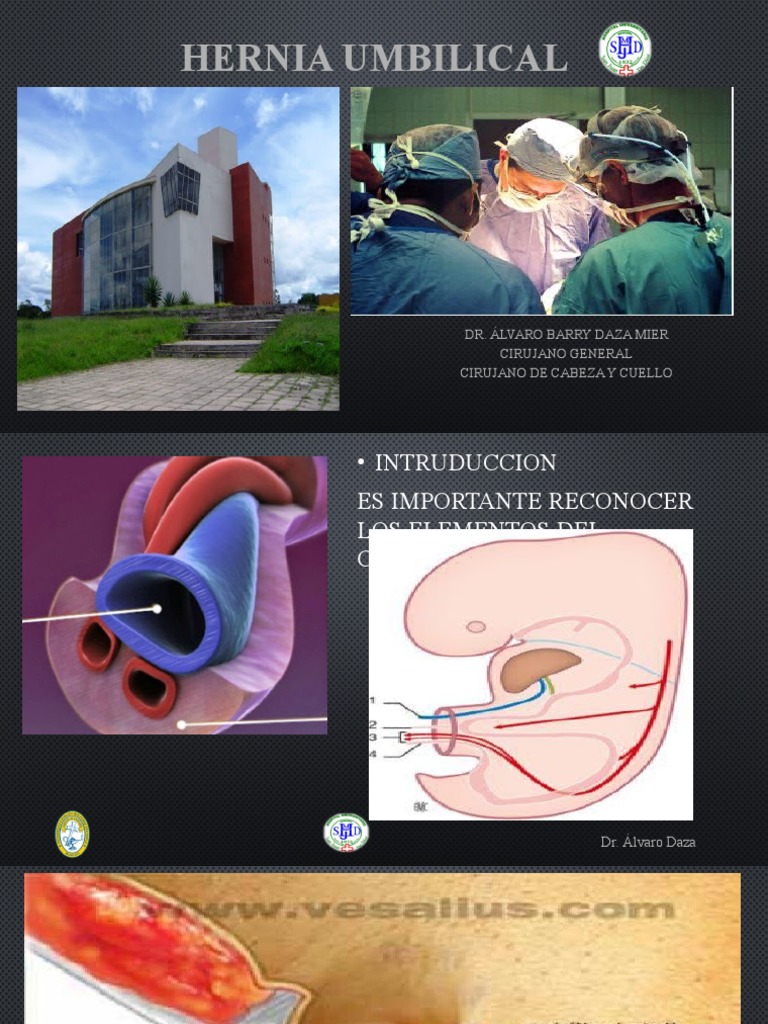 Hernia Umbilical | PDF