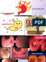 Gastritis