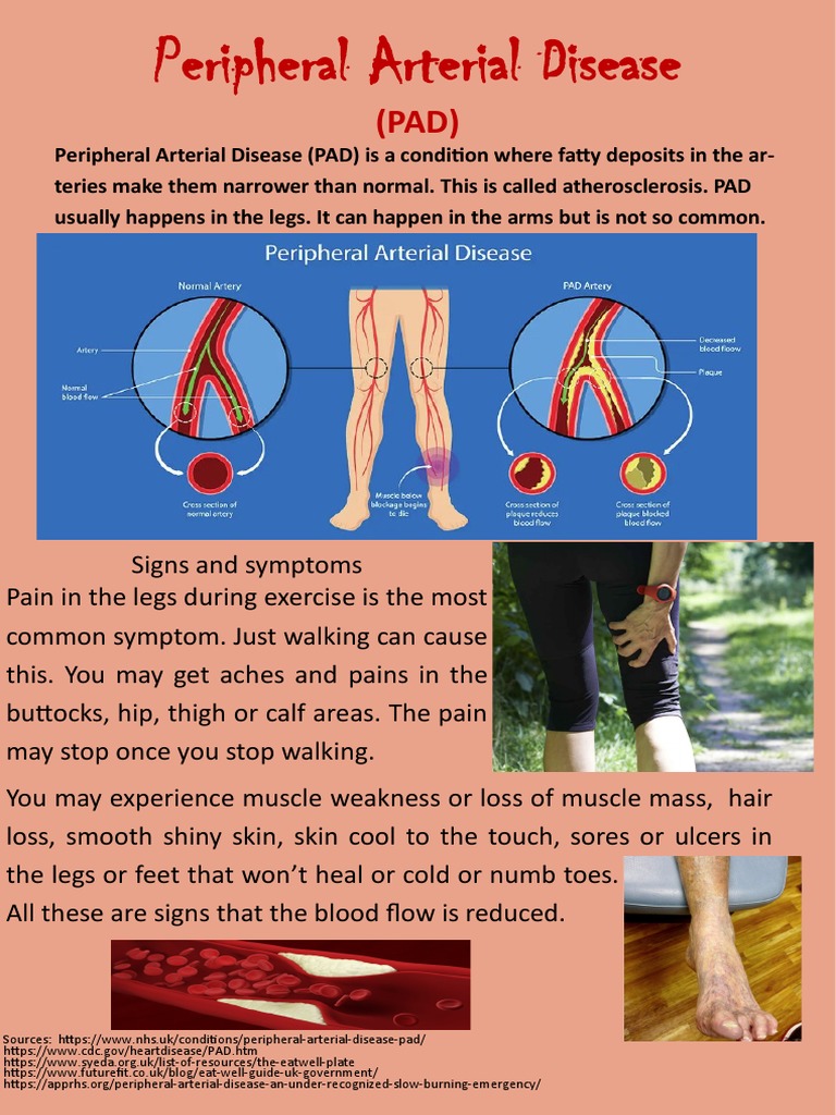 Infographic PAD PDF Human Diseases And Disorders Clinical Medicine
