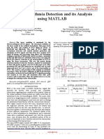 Heart Arrhythmia Detection and Its Analysis Using Matlab IJERTV10IS110176