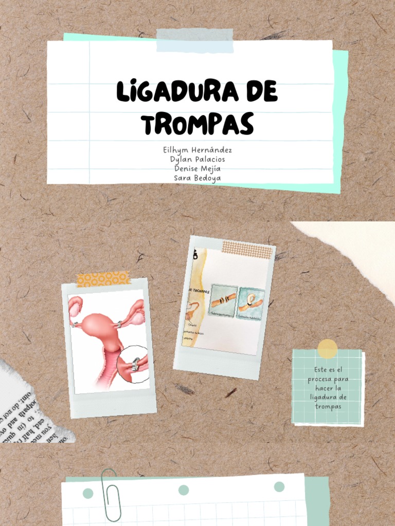 Ligadura de Trompas PDF PDF