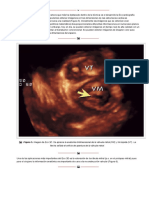 Ecocardiografía Tridimensional PDF