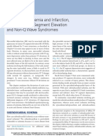 Myocardial Ischemia and Infarction, Part II Non-ST Segment Elevation and Non-Q Wave Syndromes PDF