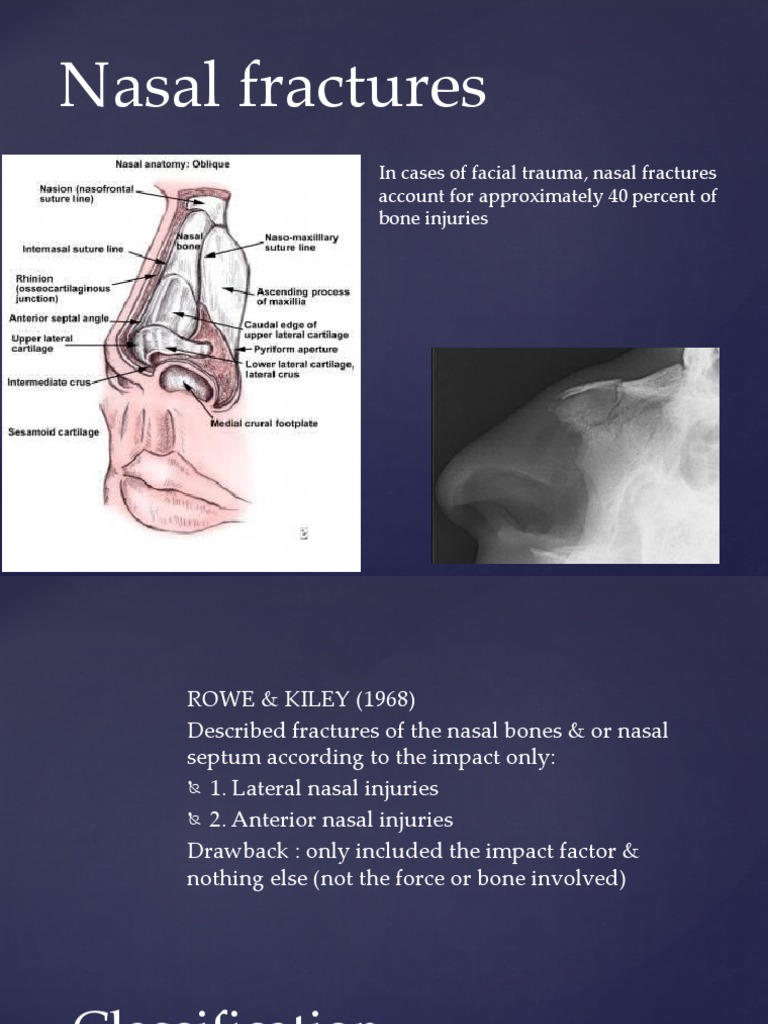 Nasal Fracture Classification and Management | PDF | Human Nose | Injury
