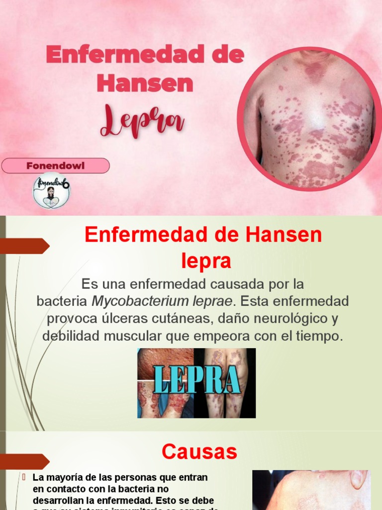 Enfermedad de Hansen PDF Lepra Síntoma