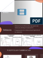 Estenosis Aórtica