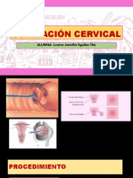 Conización Cervical Con Asa