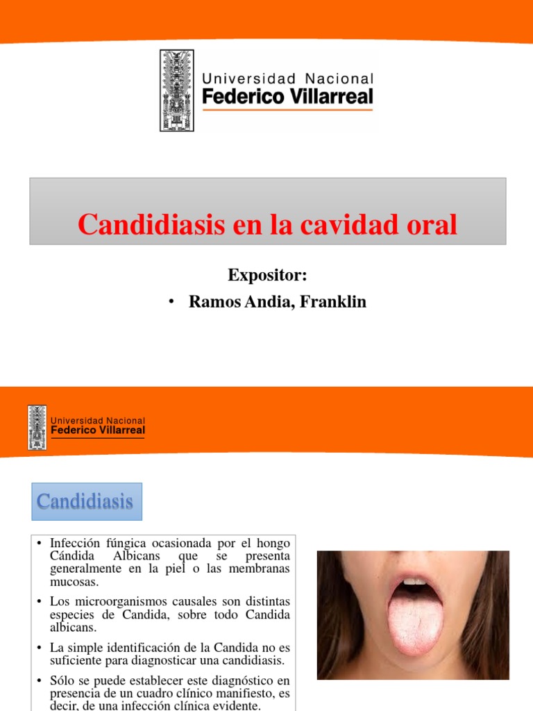 Candidiasis Oral: Diagnóstico y Clasificación | PDF | Candidiasis ...