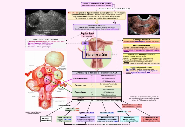 Fibromes utérins : symptômes et traitements | PDF | Utérus | Système ...