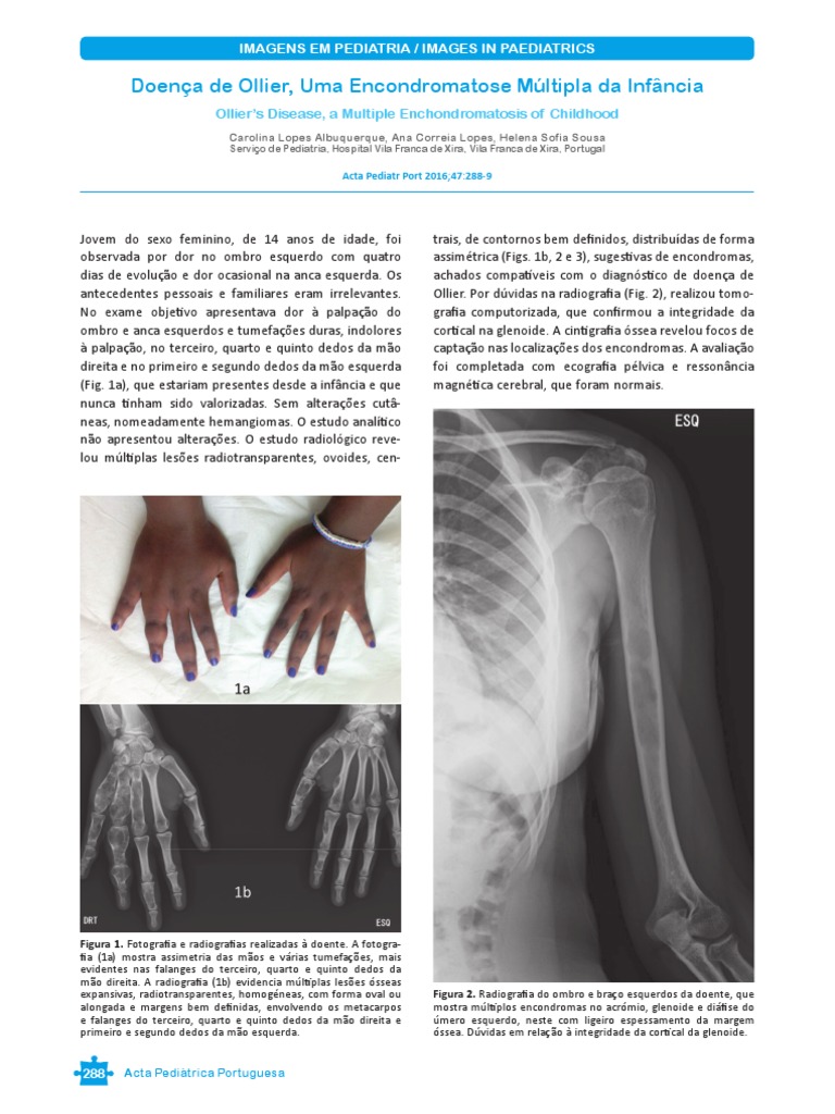 Diagnóstico da Doença de Ollier em Adolescente | PDF | Neoplasmas ...
