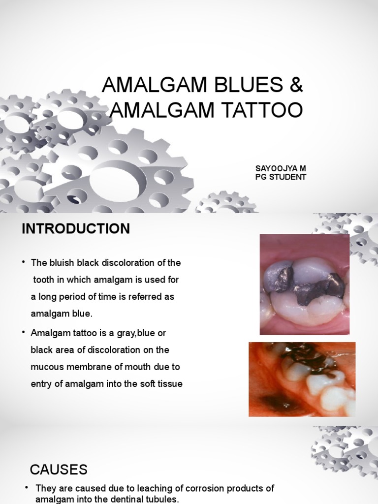 Amalgam Tattoo: Causes and Management | PDF