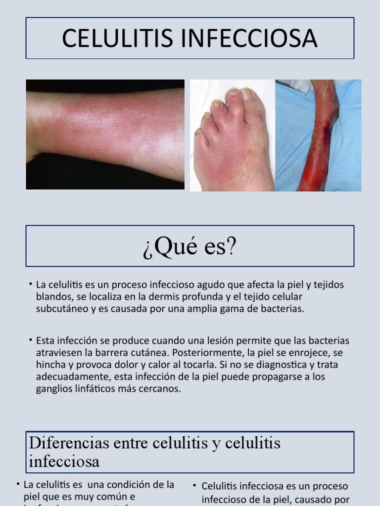 celulitis-infecciosa-causas-y-tratamiento-pdf-sistema-inmune