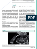 Fetal Venriculomegaly