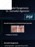 Understanding Gonadal Dysgenesis vs Agenesis