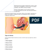 Trabalho de Ernia Umbilical