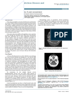 Tuberculous Mastoiditis A Rare Occurrence 2332 0877.1000113