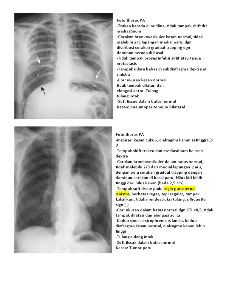 Evaluasi Foto Thorax PA dan Cor | PDF