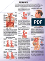 esofagitis