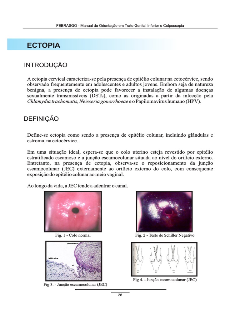 Ectopia Cervical: Definição e Tratamento | PDF | Câncer cervical ...