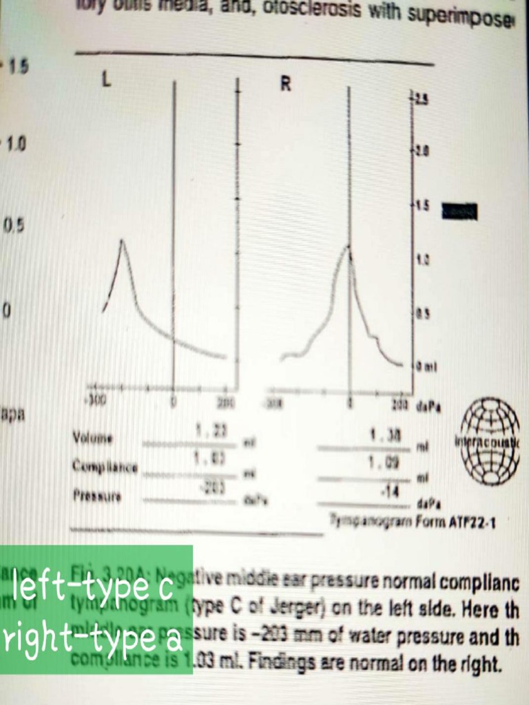 Otosclerosis Tympanogram