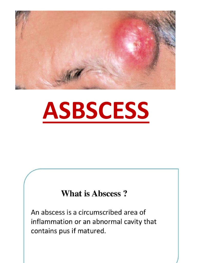 Abscess Management Guide | PDF | Causes Of Death | Microbiology