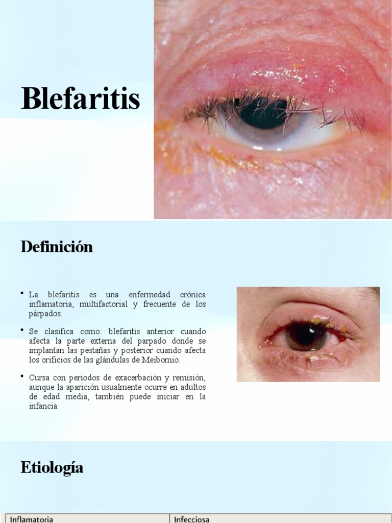 Tratamiento y Definición de Blefaritis | PDF | Enfermedades y ...