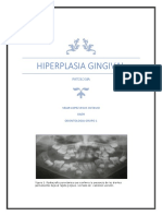 Hiperplasia Gingival