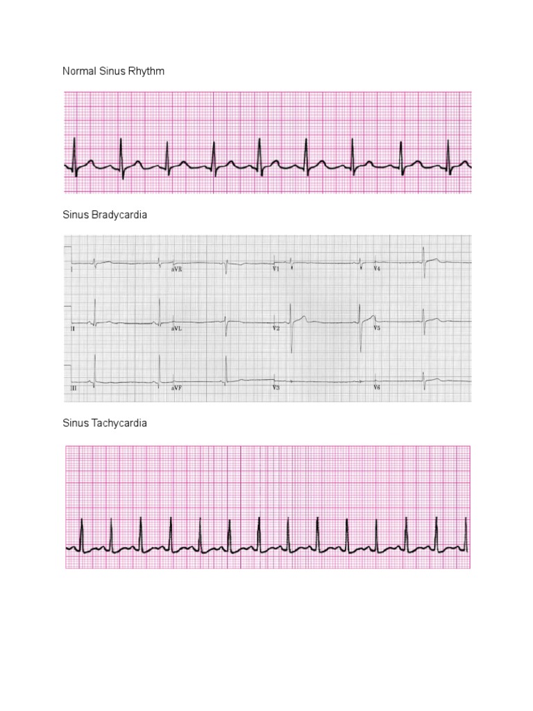 sample strip Ekg