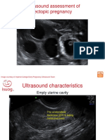 Ultrasound Assessment of Ectopic Pregnancy