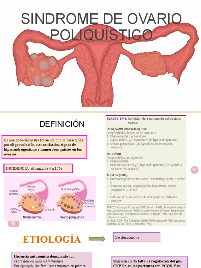 Sindrome de Ovario Poliquístico | PDF