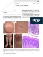 Alopecia Areata and Psoriasis Vulgaris Associated With TS