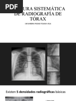 Guía de Interpretación de Rx de Tórax | PDF | Pulmón | Tórax (anatomía ...