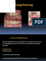 Crown Lengthening