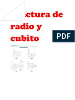 Fractura de Radio y Cubito