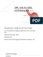 Neoplasias Del Estomago