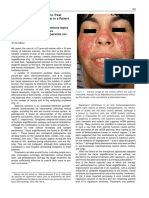 Topical Rapamycin Solution To Treat Multiple Facial Angiofibromas in A Patient With Tuberous Sclerosis