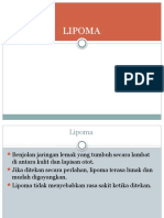 Lipoma