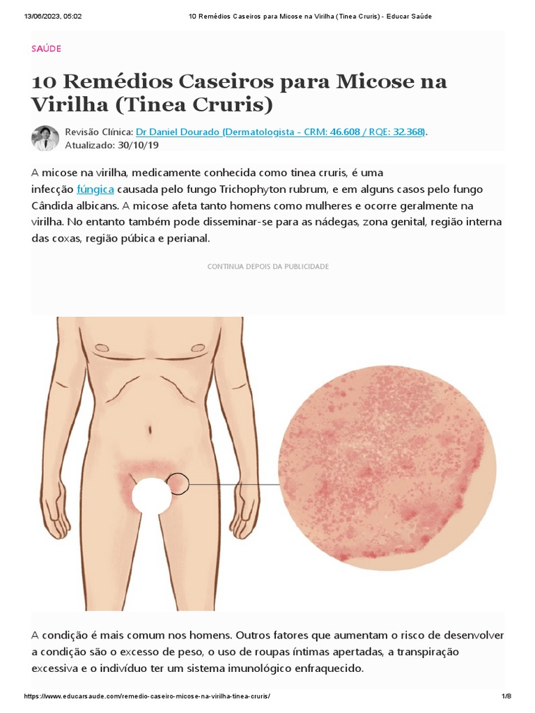 10 Remédios Caseiros para Micose Na Virilha (Tinea Cruris) - Educar Saúde, PDF, Infecção