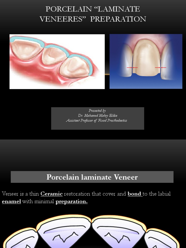 Laminate Veneer PDF Tooth Enamel Dentistry Branches