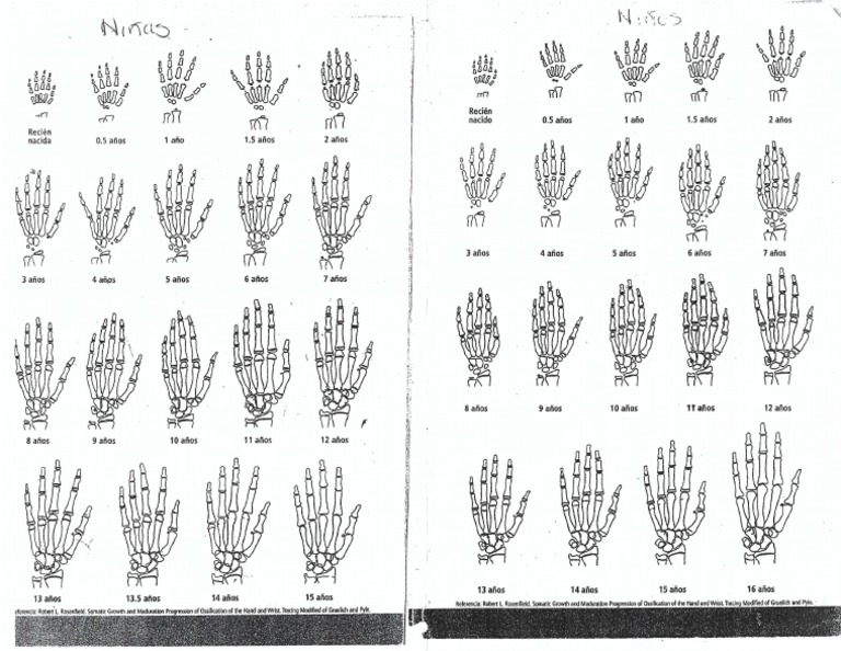 Edad Osea Arreglada | PDF