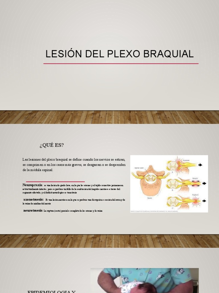 Lesion Del Plexo Braquial Pdf Nervio Parto