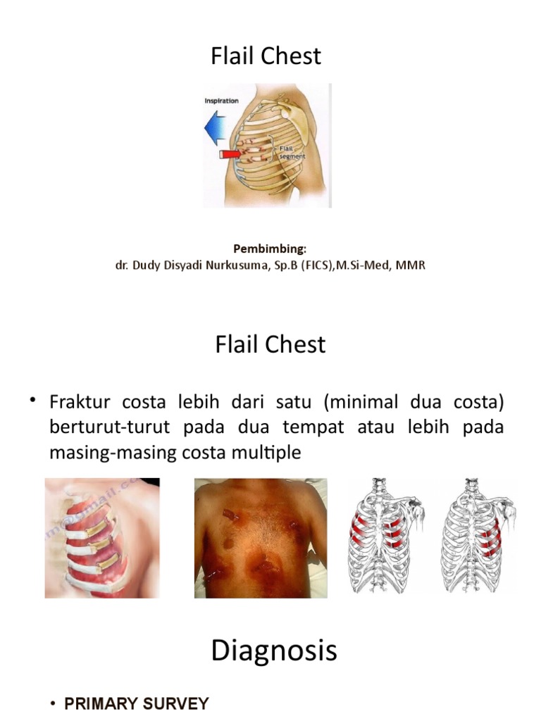 Flail Chest | PDF | Kesehatan Holistik