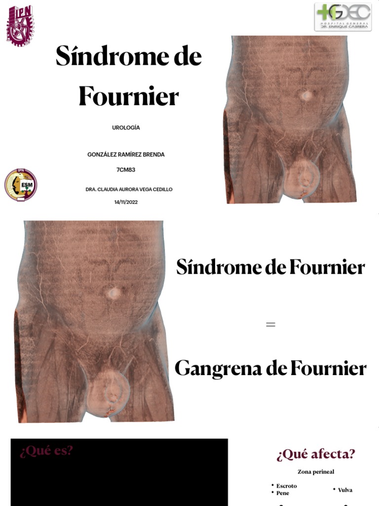 Síndrome de Fournier: Diagnóstico y Tratamiento | PDF | Epidemiología ...