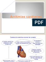 4 Arritmias Cardiacas