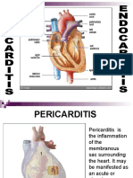 Pericarditis and Endocarditis