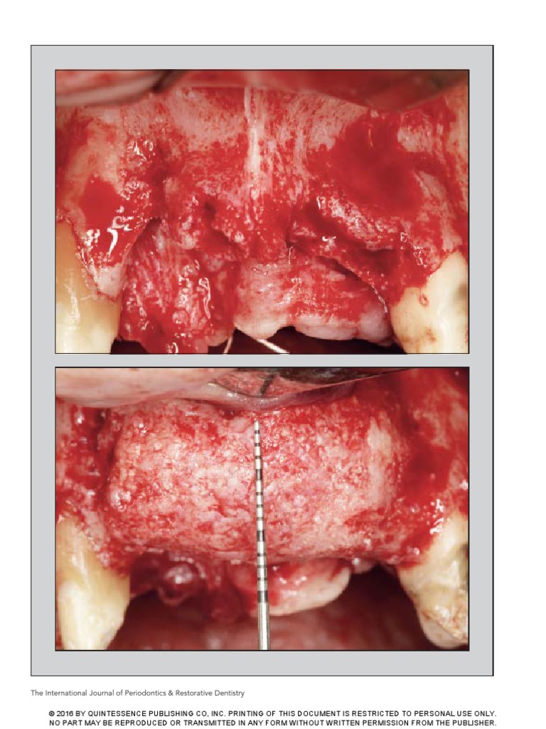 Maxillary Ridge Augmentation Techniques | PDF | Periodontology | Dental ...