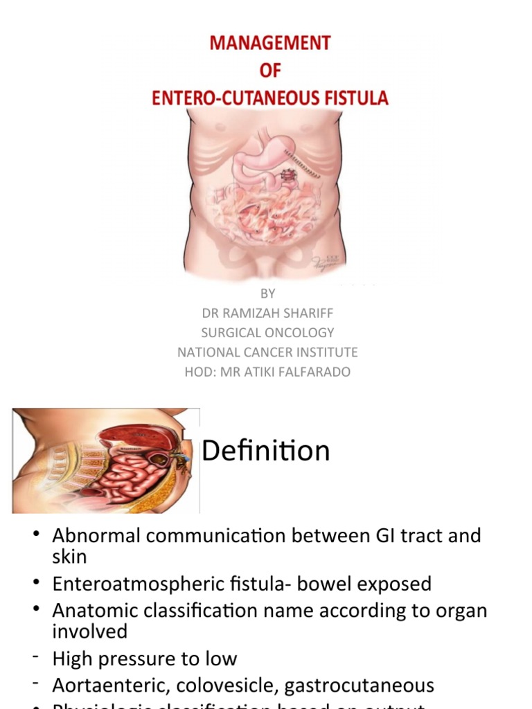 enterocutaneous-fistula-management-guide-pdf-epidemiology