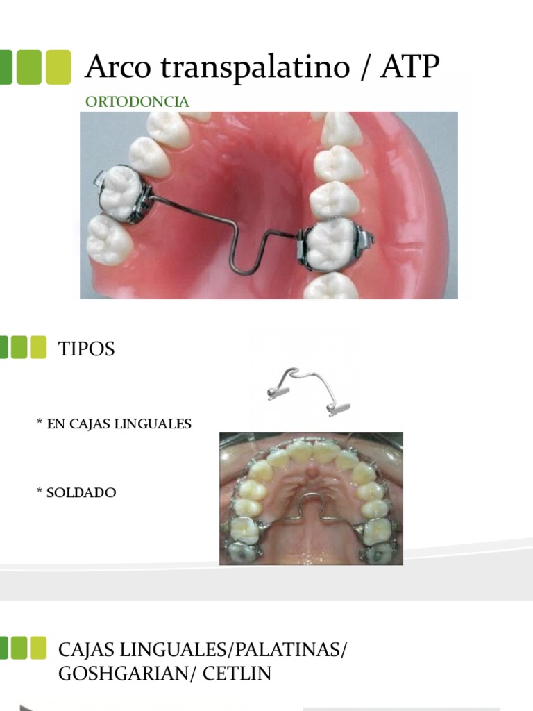 Arco Transpalatino en Ortodoncia | PDF | Ramas de Odontología